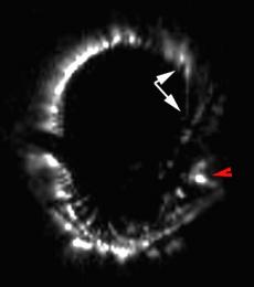 Massicard breast cr skin metastases