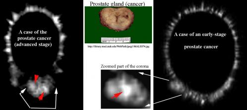 2 cases prostate cr adv ini